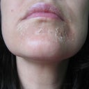 Day 5 peel 1